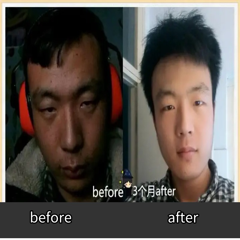 does masturbation cause pimples