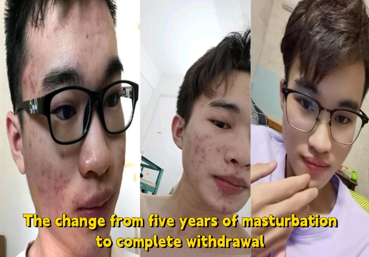 does masturbation cause pimples